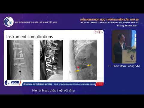 3. Hình ảnh sau phẫu thuật cột sống (TS. Phạm Mạnh Cường)