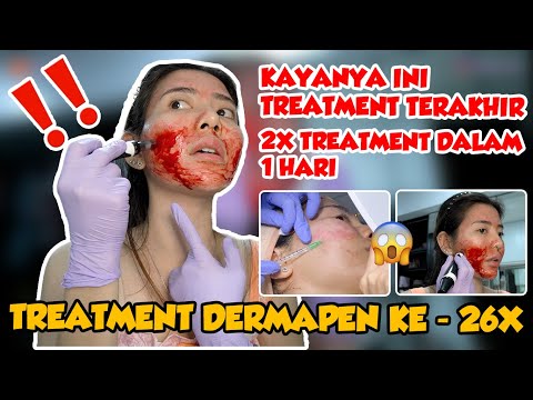 TREATMENT DERMAPEN 26X - 1 HARI 2X TREATMENT LANGSUNG😱😱