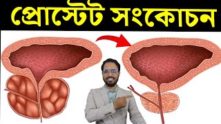 প্রোস্টেট বড়? জানুন কারণ, উপসর্গ এবং সহজ প্রতিকার | প্রোস্টেট সুস্থ রাখার সেরা খাবার ও ভিটামিন