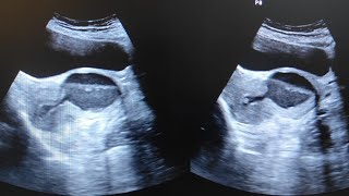 Giant Isthmocele with LSCS Scar-Niche Hematoma After 2 LSCS | Ultrasound & MRI Findings