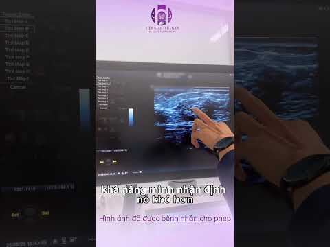 Câu chuyện thực tế từ một ca phát hiện ung thư nhờ sờ thấy khối bất thường