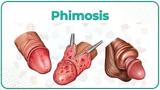 Phimosis : Etiology, Clinical features, Treatment and Complications | USMLE Step 1