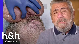El tercer intento para superar su rinofima | Dra. Sandra Lee: Especialista en piel | Discovery H&H