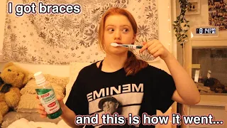 My First Days Getting Braces *What it was like for the first 48 hours and how it felt | Ruby Rose UK