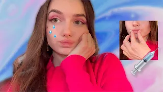 سويت فلر لشفايفي 💉والنتيجه 😱