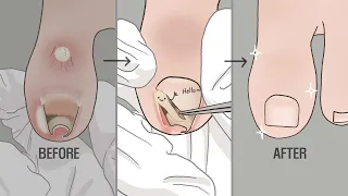 [발청소 ASMR 2탄] 눈과 귀가 시원한 내성발톱치료 애니메이션 *리얼함 주의* / LULUPANG 루루팡