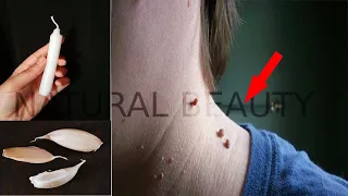 بشمعة واحدة فقط تخلصي من الثآليل ستتختفي  / علاج الزوائد الجلدية في 3 أيام ستختفي ولن تظهر مجددا