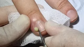 JÁ ACONTECEU ISSO COM O SEU DEDO ? #podologomaurelio #ingrowntoenail