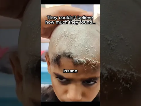 Going Bald for Dandruff ❄️⚠️