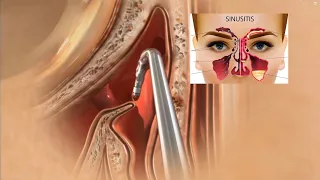 Sinus Surgery 3D Animation | Sinusitis Treatment | Sinus Operation