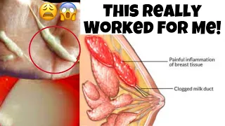 Breastfeeding Problems: Clogged Milk Ducts | Best Home Remedies That Really Works!