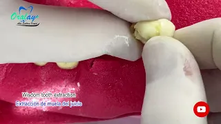 Me quedó un pedacito de muela