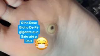 BICHO DE PÉ OLHO O TAMANHO DO OLHO DELE😷 A Little Foot Bug😵 Reaction Podologo Maurelio