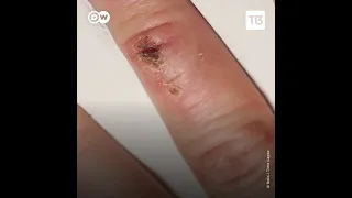 El fascinante proceso de la cicatrización: timelapse