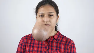 Giant Facial Tumor on Face Pre Surgery Complete Consultation