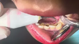 Cleaning teeth #dentist #teethdecay #dentaltreatment 