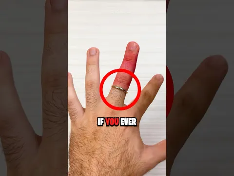How To Remove a Stuck Ring! 😨