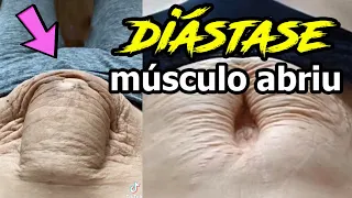 DIÁSTASE : O Músculo Abriu!!! E Agora??? Como tratar a diastase com abdominoplastia