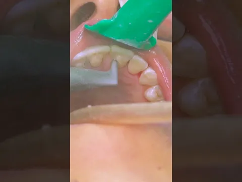 .تنظيف و تلميع الأسنان  مع د.نيرمين إبراهيم  ( طبيب ممارس عام)——  #alkharashy_dental_center #qatar