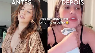 3 ANOS DEPOIS DE UM ERRO ESTÉTICO  - harmonização que deformou o meu rosto