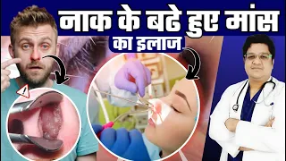 Nasal Polyps - नाक के बढ़े हुए मांस का इलाज | नाक का मांस क्यों बढ़ जाता है | कारण, लक्षण और इलाज