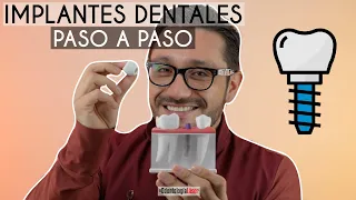 ¿Cómo se ponen los Implantes Dentales Paso a Paso? 🔩 ¿Duelen? - Odontología Láser.
