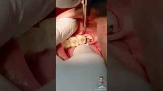 خلع ضرس عقل سفلي كامل في أقل من دقيقة|| Extraction of lower right third molar