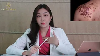 Keloid အမာရွတ် အကြောင်းသိကောင်းစရာများ