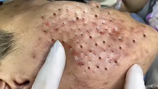 Big Cystic Acne Blackheads Extraction Blackheads & Milia | Whiteheads Removal Pimple Popping 