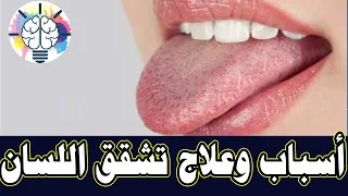 أسباب وعلاج تشقق اللسان