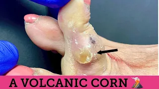SHAVING OF ENORMOUS CORN ** WHAT'S UNDERNEATH IT?