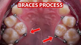 Braces process (2 year)
