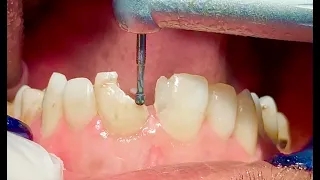 Fractured Front Tooth Restored with Composite \ Incredible Transformation