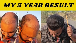 HOW HAIR TRANSPLANT LOOKS AFTER 5 YEARS ? #tannudada