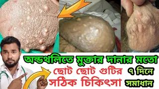 অন্ডকোষে ছোট ছোট গোটার কারণ লক্ষন ও সঠিক চিকিৎসা ৷ Sebaceous Cyst on Scrotum, অন্ডকোষের সিস্ট