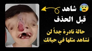 شاهد قبل الحذف 😰 حالة نادرة جداً لن تشاهد مثلها في حياتك ❤ (سبحان الله) 