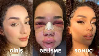 BİR BURUN AMELİYATI İLE NE KADAR DEĞİŞEBİLİRSİN? | ESTETİK SORU - CEVAP!