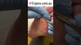 Slomo callus cutting from foot in podiatry clinic full video :)