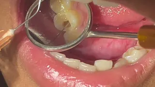 Root canal treatment #dentist #dentalprocedure #smiledesigndental #dentaltreatment #dental 