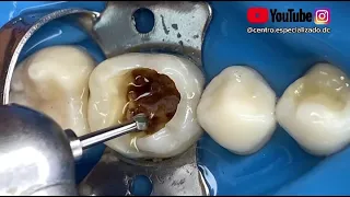 ¡Doctor mis caries son pequeñas!