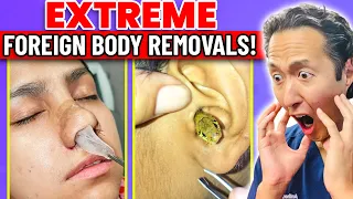 Doctor Reacts to EXTREME & SATISFYING Foreign Body Removals 1!
