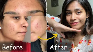 This Changed my life….! | No product | No doctor | Acne journey Tamil