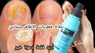 بقرعة بيتادين علاج فطريات الأظافر والكزيما للأبد /وصفة تغنيك عن طبيب/ #مجربة /أريد فقط دعوة خير