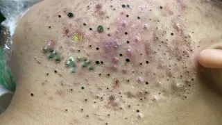 ニョキニョキ角栓/スポスポ角栓除去/𝐫𝐞𝐥𝐚𝐱/𝐒𝐚𝐭𝐢𝐬𝐟𝐲𝐢𝐧𝐠/𝐧𝐨𝐬𝐞 𝐛𝐥𝐚𝐜𝐤𝐡𝐞𝐚𝐝𝐬/𝐭𝐰𝐞𝐞𝐳𝐞𝐫𝐬/𝐚𝐜𝐧𝐞 𝐭𝐫𝐞𝐚𝐭𝐦𝐞𝐧𝐭/ピンセット/피지제거𝐍𝐨.31