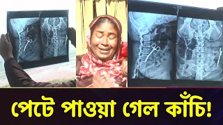অপারেশনের ২০ বছর পর পেটে পাওয়া গেল কাঁচি! Meherpur News | Bangla TV