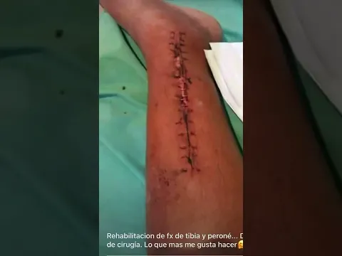 Rehabilitación fractura de tibia y peroné