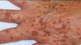 CÓMO ELIMINAR MANCHAS OSCURAS DE LAS MANOS. MANCHAS DE LA EDAD.