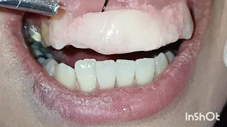 Safe & Precise Removal of Old Dental Restorations