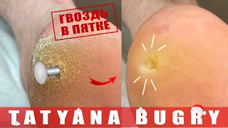 ГВОЗДЬ В ПЯТКЕ / МОЗОЛЬ 35-летней ДАВНОСТИ 😱 ПРОДОЛЖЕНИЕ ИСТОРИИ #ТатьянаБугрий