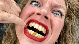finally fixing my dirty, rotten, crooked teeth!